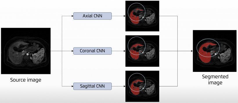Example of using a multi-planar CNN configuration to improve liver segmentation
