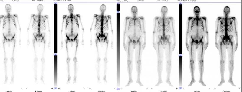 Diffuse osseous metastasis of a prostate carcinoma pre-therapy (four pictures...