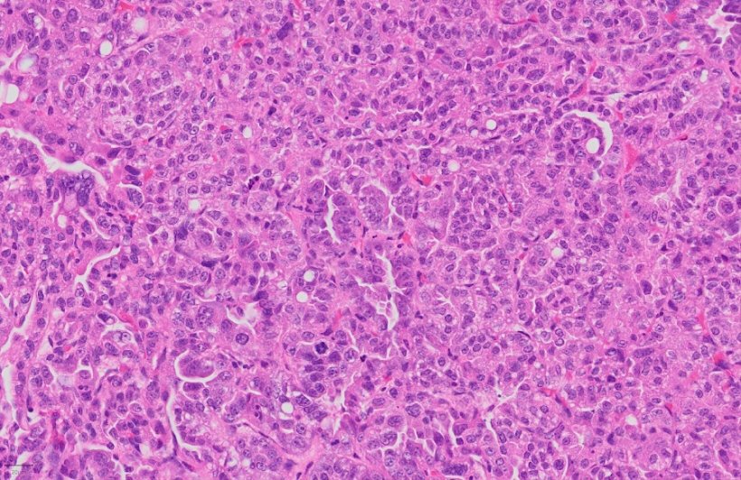 Histological staining of a lung adenocarcinoma, which is made of tumor cells as...