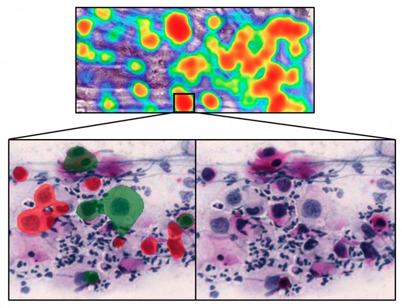 Precancerous lesions in a PAP smear identified by AI