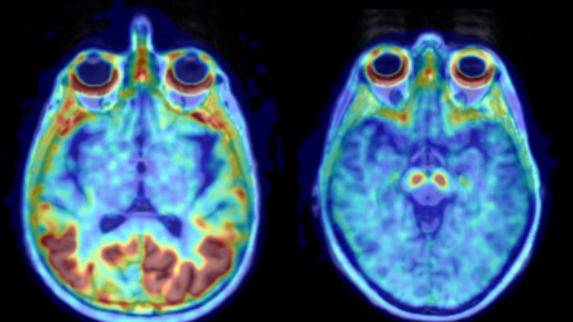 Pathological uptake of tau, to the left. A healthy brain, to the right.