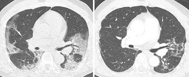 CT einer Covid-19 Pneumonie bei einem 61-jährigen Mann. Linkes Bild: Im akuten...