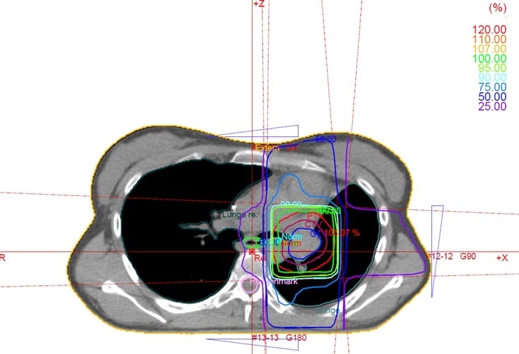 Bestrahlungsplan bei zentraler Lymphknotenmetastase.