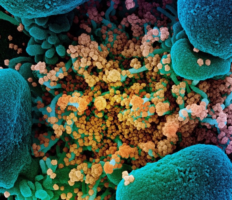 Colorized scanning electron micrograph of a dying cell (blue) heavily infected...