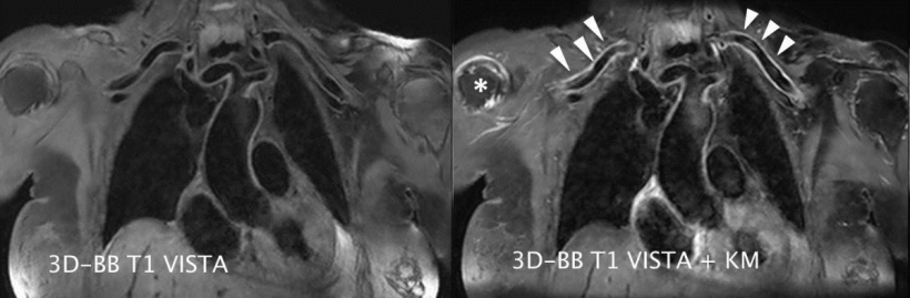 72-year-old patient with polymyalgia rheumatica and known giant-cell arteritis....