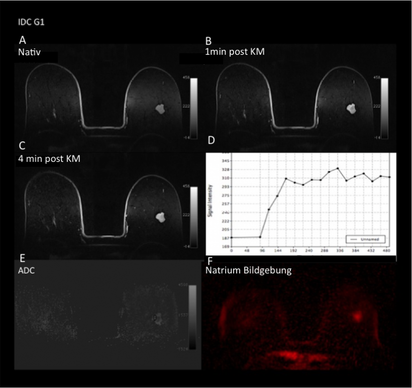 mMRI with DCE-MRI, DWI and Sodium Imaging: Female patient with lowgrade,...