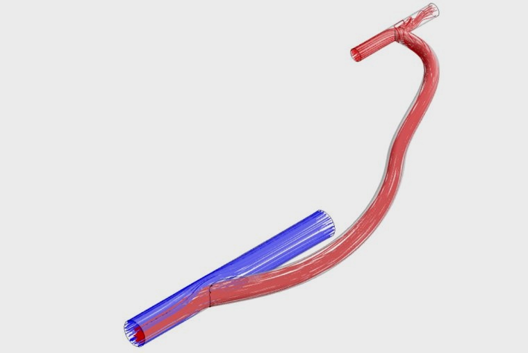 Rendering of an arteriovenous graft. The blue section represents a vein, the...