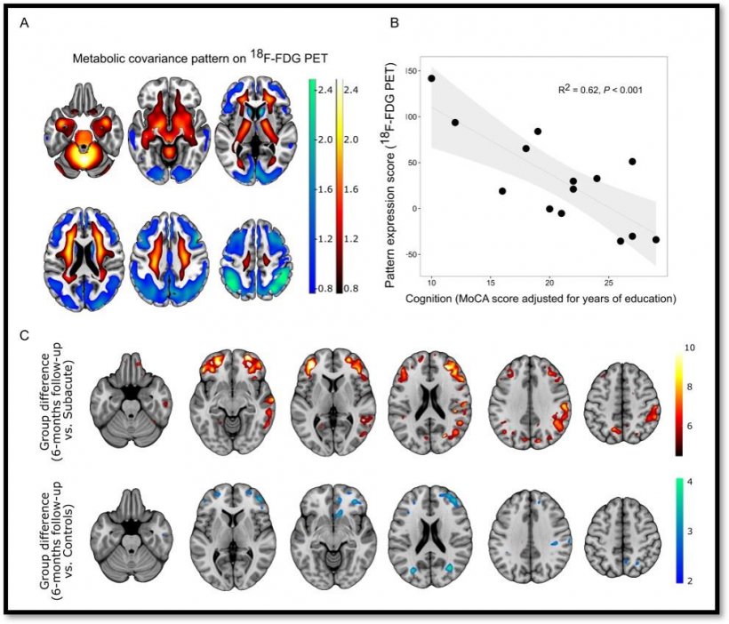 A: Covid-19-related spatial covariance pattern of cerebral glucose metabolism...