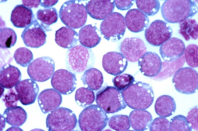 Epstein-Barr Virus (EBV), stained with Hematoxylin and eosin (H&E)