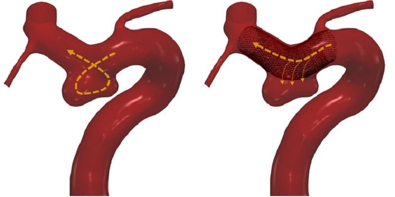 A (virtual) blood vessel with an aneurysm. Left: before the blood diverter is...