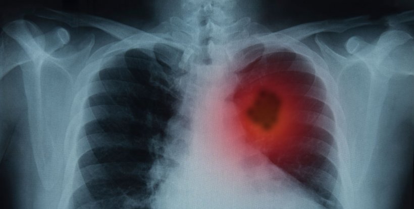 lung cancer on xray