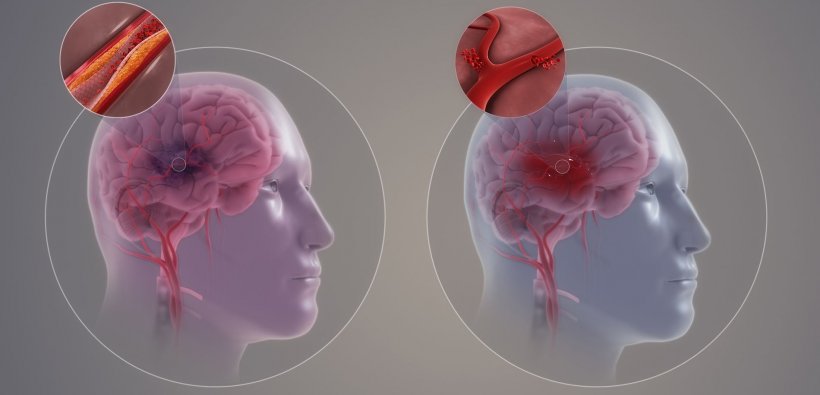 illustration of ischemic stroke and hemorrhagic stroke