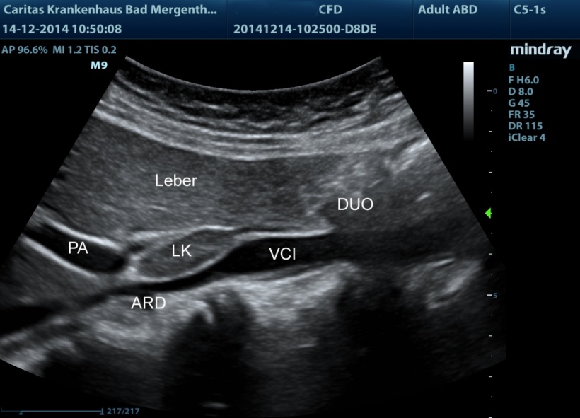 A perihepatic lymph node (LK) situated between hepatic portal vein (PA) and...