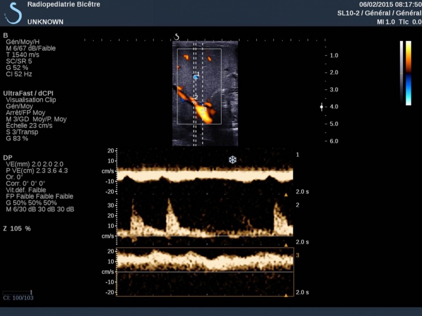 UltraFast Doppler displays multiple spectrums in a single image in this...