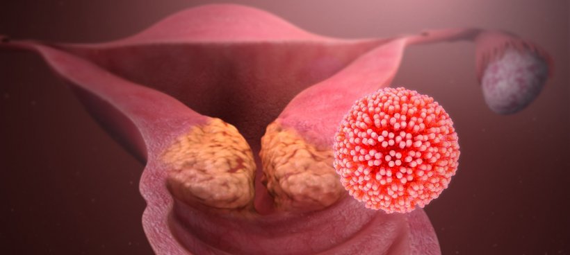 illustration of cervical cancer caused by hpv infection