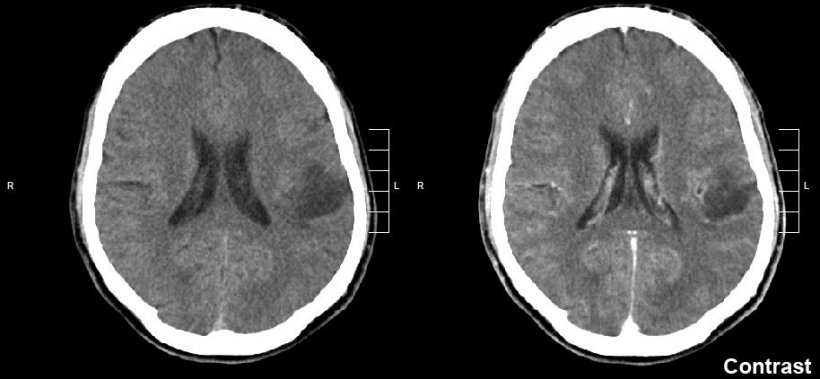 brain glioma in ct scan