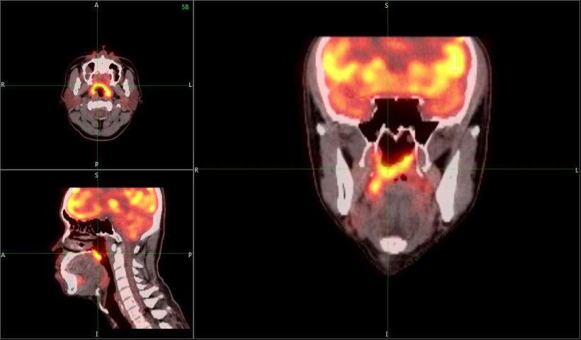 pet scan of head and neck