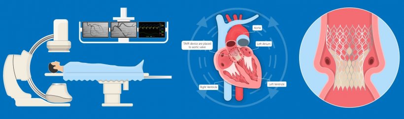 TAVI: from short-term effects to lifetime management