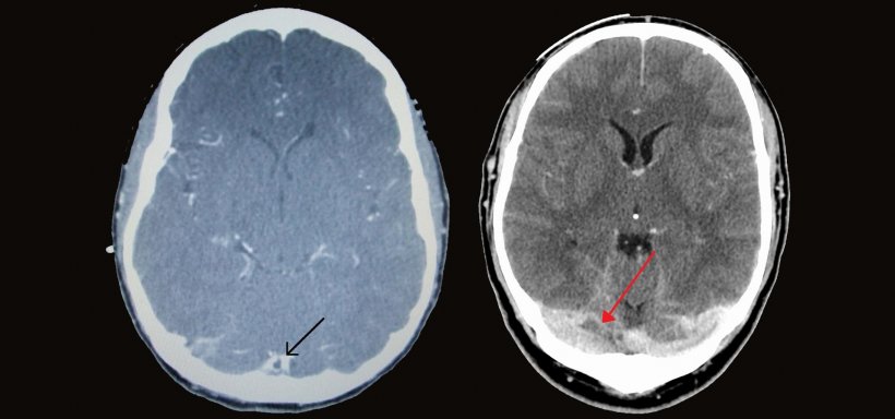 Left: CT venogram showing a filling defect in the sagittal sinus (black...