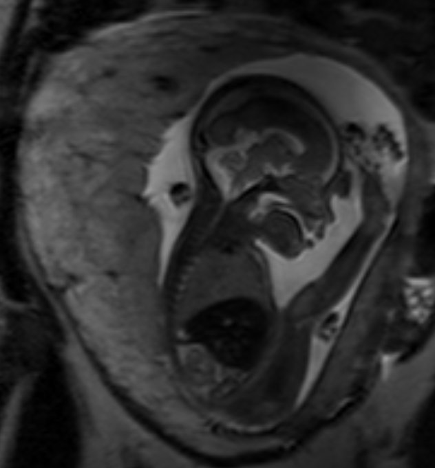 MRI image of the uterus with unborn child inside, and the placenta