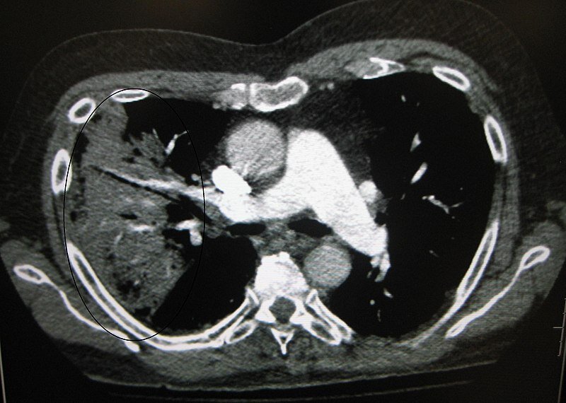 CT of the chest demonstrating right-sided pneumonia ( left side of the image ).