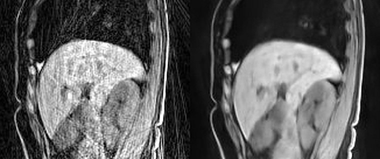 Example images reconstructed using (A) regridding or (B) the Phase2Phase method...