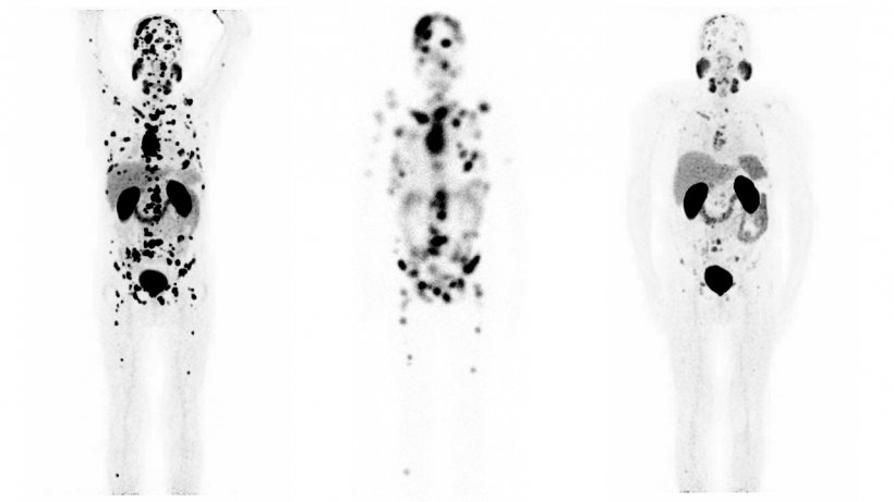 Das linke und das mittlere Bild zeigt die Tumormasse bei Beginn der...