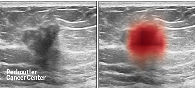 Breast ultrasound images show cancer (at left, as dark spot in center and, at...
