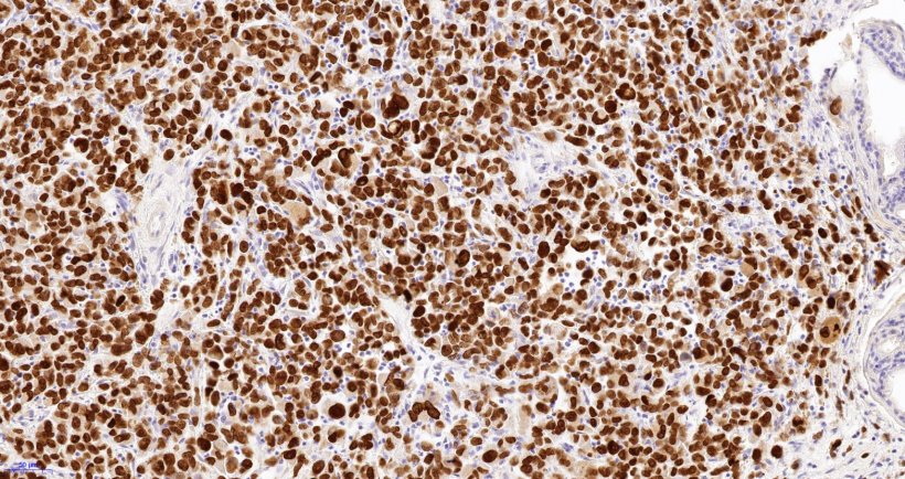 Image of prostate cancer tissue that shows the human cells within the tumour in...