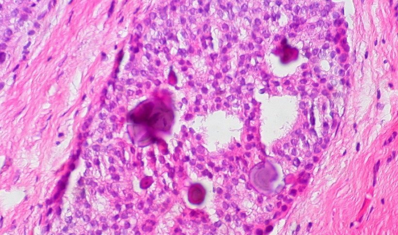 Histological slide of ductal carcinoma in situ (DCIS) with calcifications
