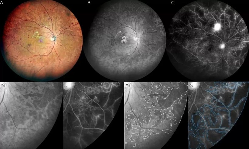 Concordance of hyporeflective areas in the blue widefield scanning laser...