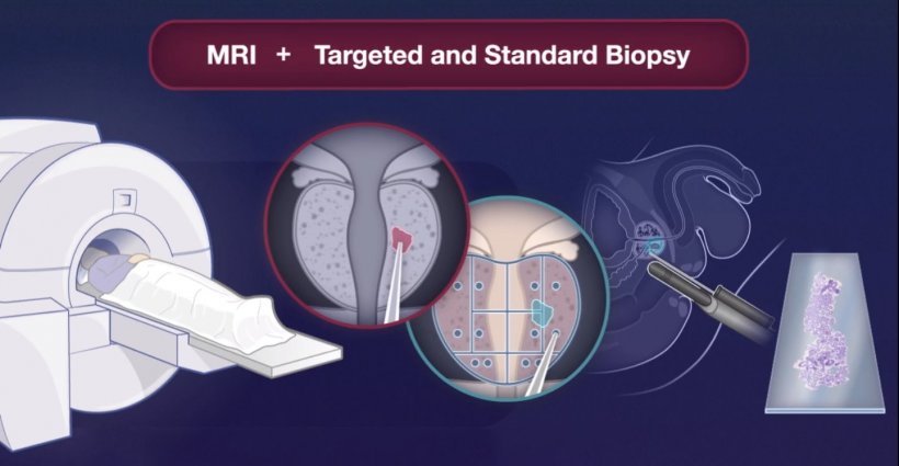 MRI + targeted and standard biopsy is noninferior to standard biopsy to detect...