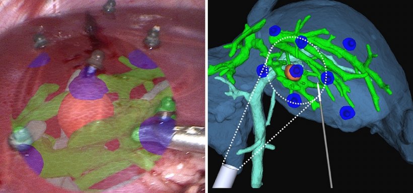 AR laparoscopic image