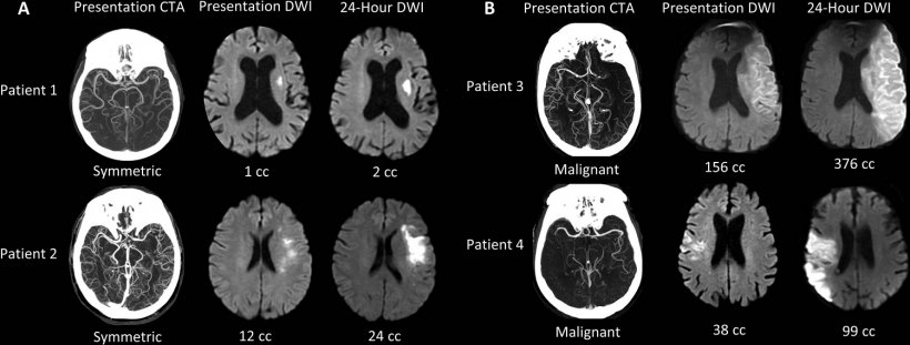 Collateral patterns at presentation CT angiography (CTA) and corresponding...