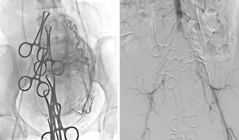 Left picture: uterine embolisation being performed on the left side following...