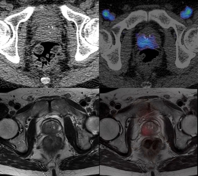 Gallium 68-PSMA PET/CT (top row) and PET/MRI (bottom row) images showing the...