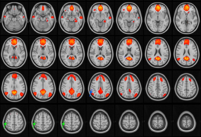 MRI images of the brain, with the default mode network (DMN) highlighted in...