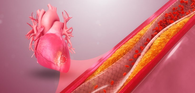 Illustration of coronary artery disease (CAD)