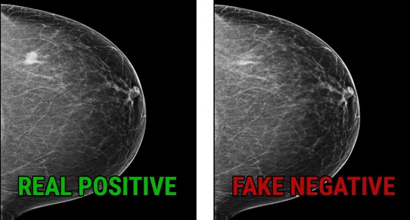 Mammogram images showing a real cancer-positive (left) case, with cancerous...