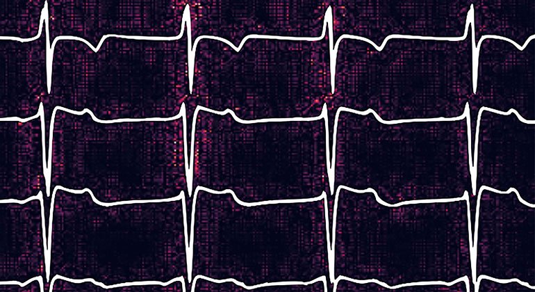 electrocardiogram reading