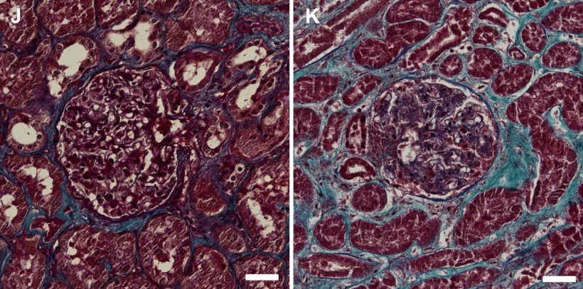SARS-CoV-2 is present in Covid-19 patient kidney cells and induces fibrosis:...