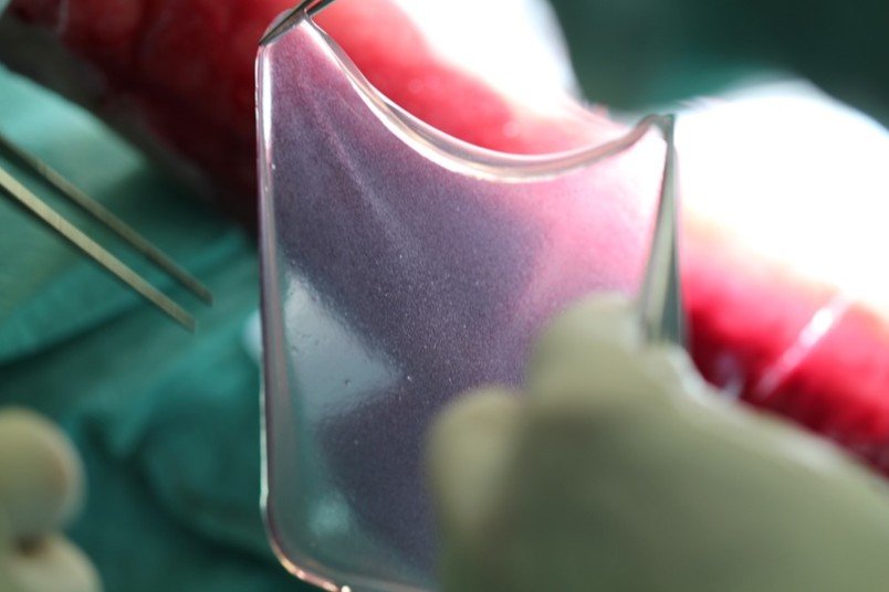 Stammzelltransplantat intraoperativ: Fibrinsheet mit den darauf befindlichen...