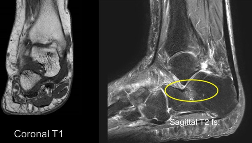 Laterales Impingement/Impaction mit ödemartigen Knochenmarksveränderungen bei...