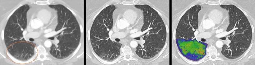 Darstellung der Lunge eines Post-Covid Patienten mit quantenzählender CT. Die...