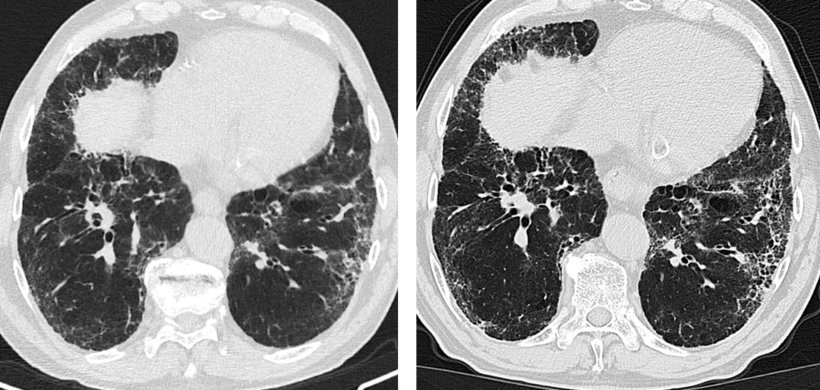 CT scans of lung with usual interstitial pneumonia