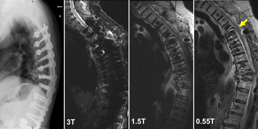MRI imaging of spine