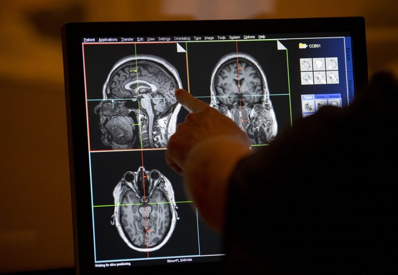 A researcher examines an MRI from a participant in the Cleveland Clinic Brain...