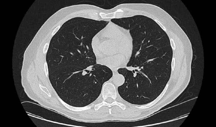 low dose ct scan of human lungs