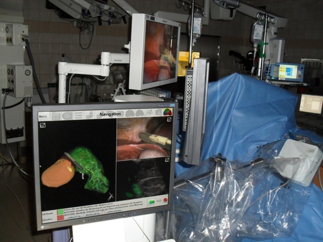 Fiberglass navigation during a laparoscopy.