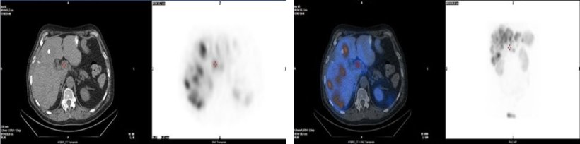 Radiotherapy: Nuclear waste as a potential source?